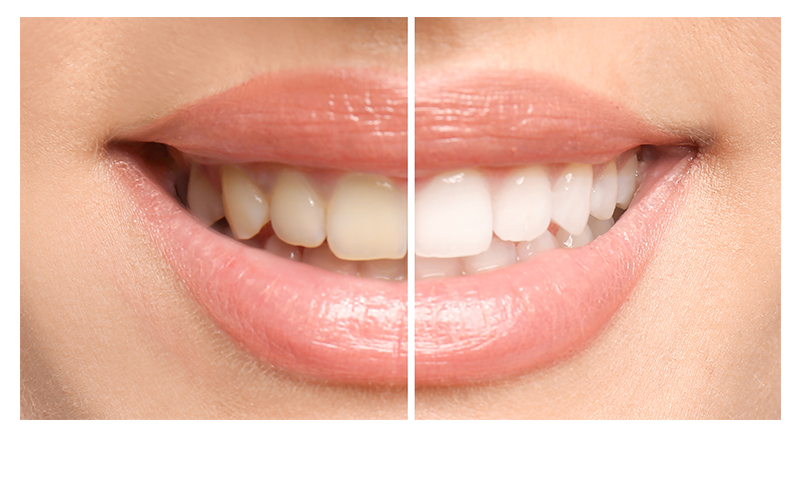 Dental Concepts | Dental Fillings, Juvederm® and Oral Cancer Screening