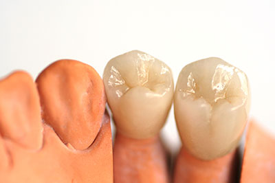 Dental Concepts | Sports Mouthguards, Implant Dentistry and Extractions
