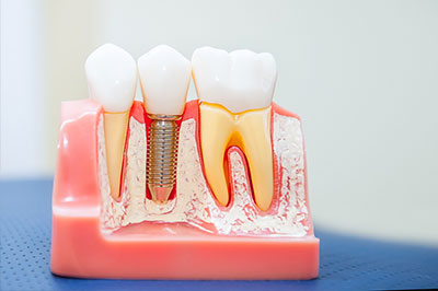 Dental Concepts | Preventative Program, Periodontal Treatment and TMJ Disorders