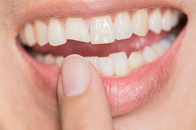 Dental Concepts | Night Guards, Ceramic Crowns and Dental Fillings