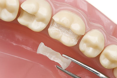 Dental Concepts | Root Canals, Dentures and Extractions